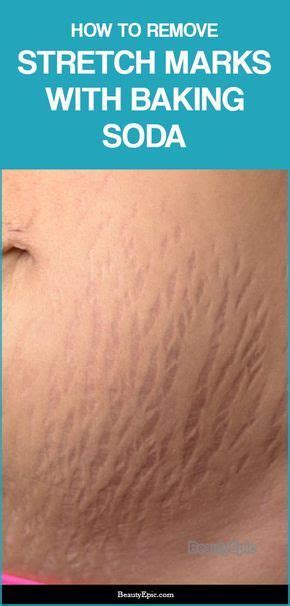 Stretch Mark Removal, How To Remove Stretch Marks, Ingrown Hair, Tips Belleza, Natural Cures ...