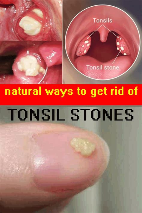 Oral Cancer White Spots On Tonsils - Printable Templates Free