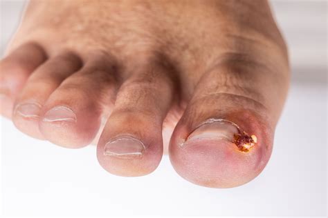 Ingrown Toenail Infection: Symptoms, Treatment, Causes