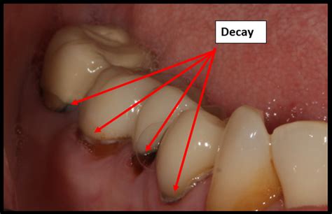 Cavity Side Of Molar