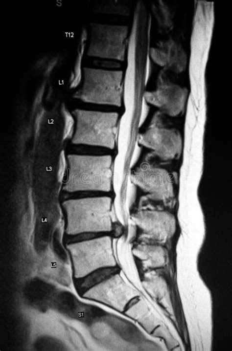 Patologia Severa Del Mri Di Herniation Del Tratto Lombare Della Colonna ...