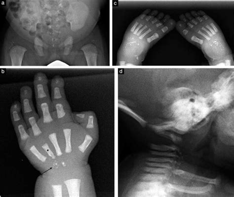 Prenatal diagnosis of brachytelephalangic chondrodysplasia punctata: case report - Benaicha ...