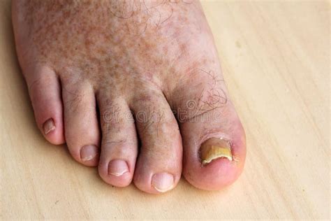 Photos de Toe Infections - Photos de stock gratuites et libres de droits de Dreamstime