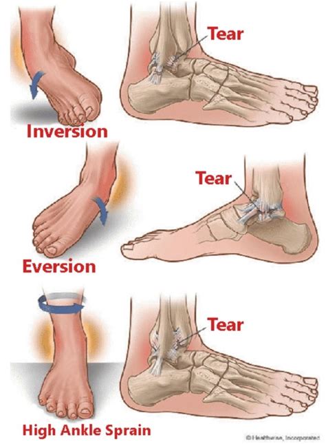 Ankle Sprains Causes And Symptoms Ankle Sprain Grades - vrogue.co