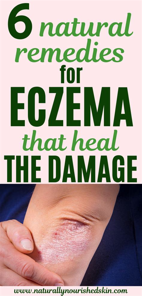 These natural remedies for eczema both heal and repair your skin! #eczematreatment # ...