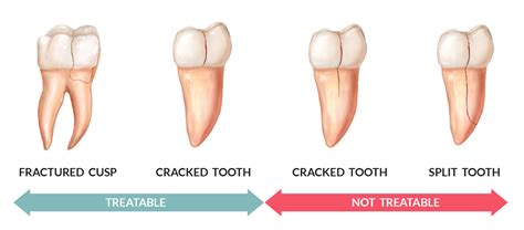 Cracked Tooth - Dental treatments abroad, Dental Clinic Heraklion Crete Uncategorized