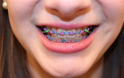 Braces for Children - Best Orthodontist NYC