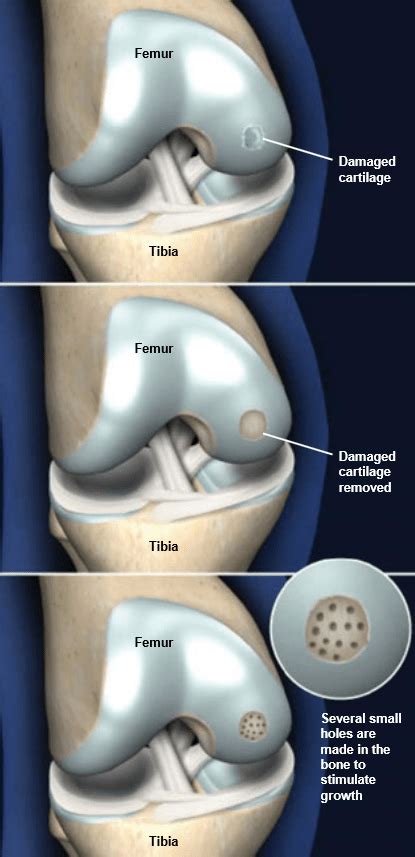 Knee Cartilage Defects - microfracture - Adam Watson Orthopaedic Surgeon