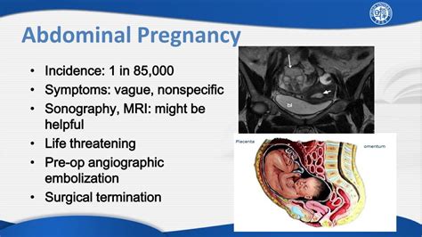 PPT - Ectopic Pregnancy PowerPoint Presentation, free download - ID:2176500