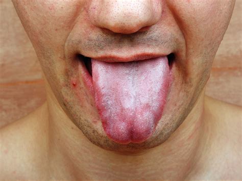 Burning Tongue: 5 Common Causes & How To Treat