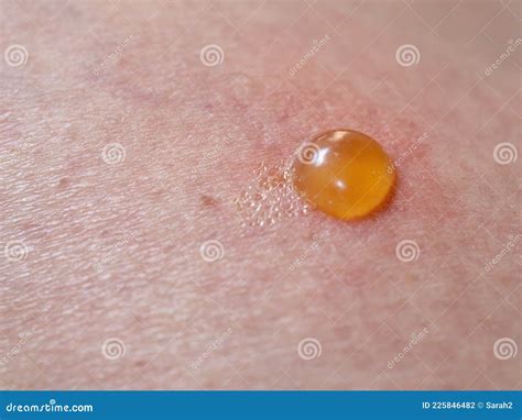 Insect Bite on Skin with Blister. Stock Photo - Image of dermatology, itchy: 225846482
