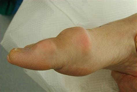 Modern Techniques in Hallux Rigidus Surgery - Clinics in Podiatric ...