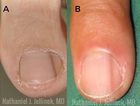 Hutchinson Sign Nail Melanoma - Nail Ftempo