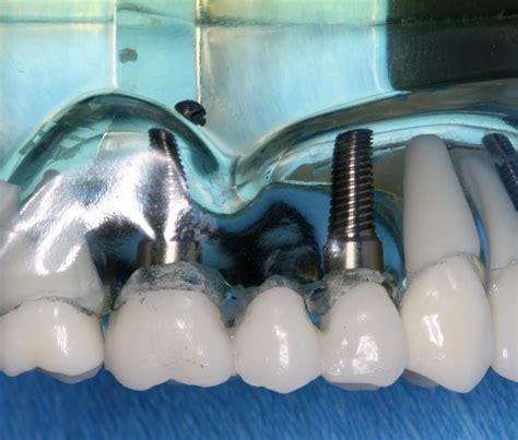 Dental Bridges: types, common problems, pros and cons, cost, NHS