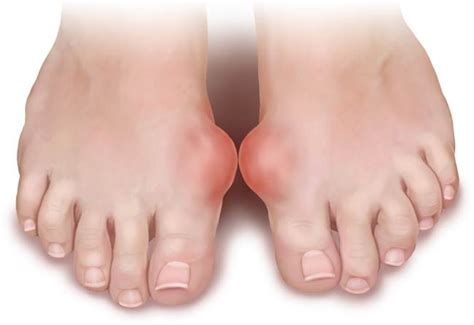 Gout symptoms pictures, Tophus for gout photos, Gout on the feet images