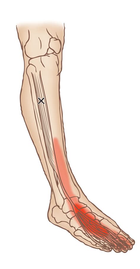 Extensor digitorum longus - Trigger Point - Learn Muscles