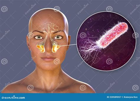 Pseudomonas Aeruginosa Bacteria As a Cause of Sinusitis Stock Illustration - Illustration of ...