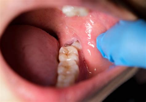 Why is my gum so swollen around my wisdom tooth? (Explained)