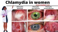 Chlamydia infection