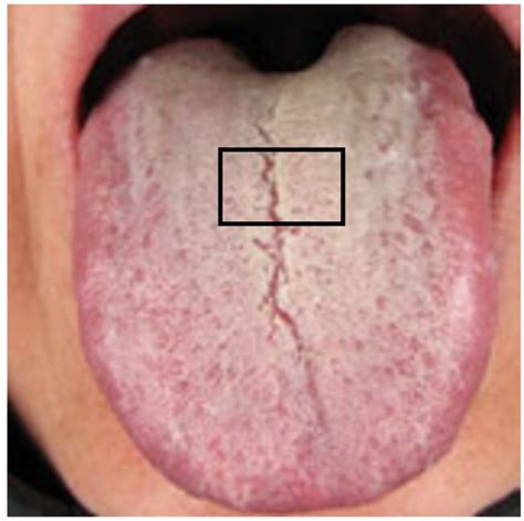 Diagnosis Tongue Problems