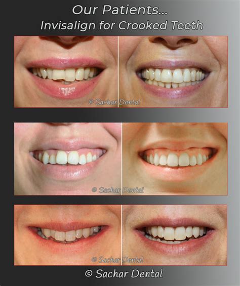 Dentist NYC | Invisalign for Crowded Teeth | Sachar Dental NYC