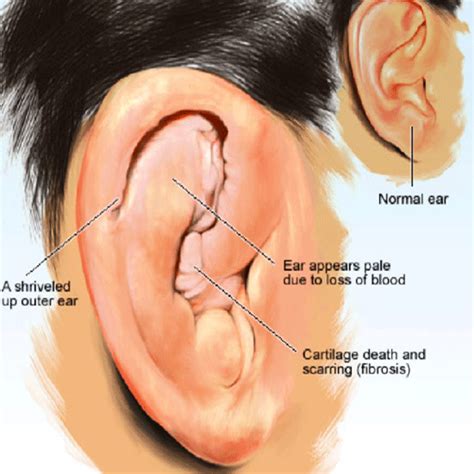 AURICULAR PERICHONDRITIS Inflammation of the fibrous tissue over the outer ear cartilage (Pinna ...