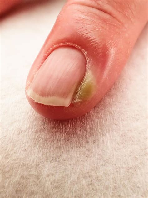 Common Fingernail Problems in Children That Should Not Be Ignored - Health Hearty