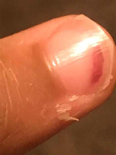 Is this a melanoma or is it a normal nail bed injury? : r/Melanoma