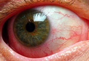 👉 What is iridocyclitis - Causes, Symptoms, Types, Treatment (February ...