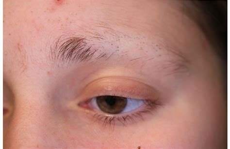 Patient with trichotillomania presenting with irregular, patchy ...