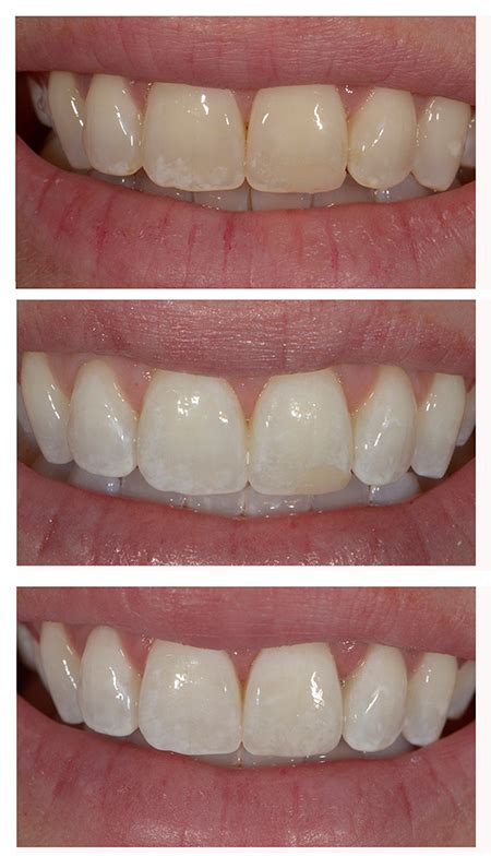 Smile Makeover: Teeth Whitening With Replacement Composite Bonding ...