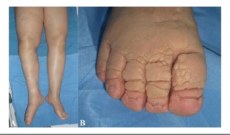 Elephantiasis Nostras Verrucosa