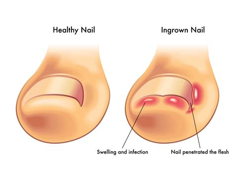 The Insufferable Ingrown Toenail | Strash Foot & Ankle Care