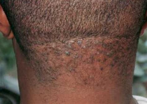 Razor Bumps Symptoms And Causes