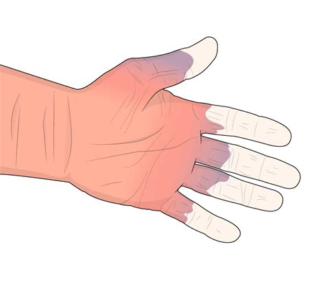 Hand Arm Vibration Syndrome – Causes and Prevention - kienitvc.ac.ke