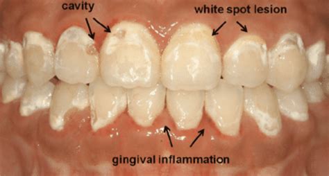 Braces Cause Teeth Stains? (How to Prevent Them)