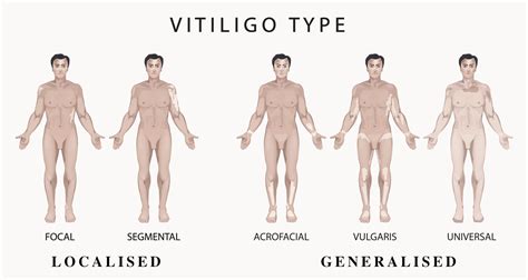 What is Vitiligo? | Causes, Signs, Symptoms, & More | Vitiligo Society