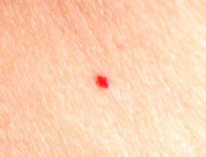 What Causes Little Red Dot on the Skin? | New Health Advisor