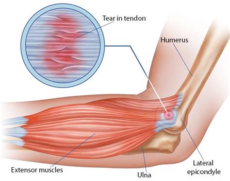 Bicep Tendonitis Elbow Deals Clearance, Save 62% | jlcatj.gob.mx