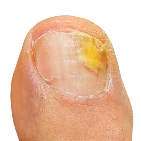 Distal Subungual Onychomycosis Home Remedies