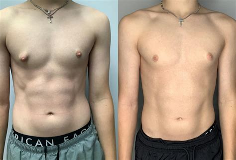 Patient 122931911 | Gynecomastia Before & After Photos | Arroyo Plastic ...