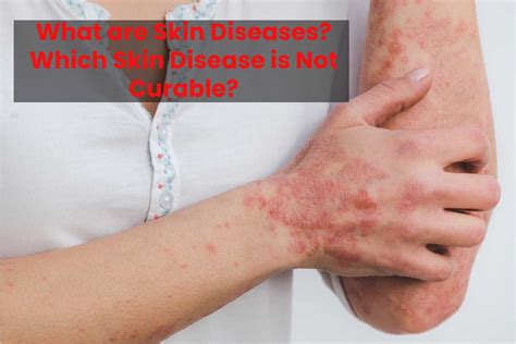 New Skin Disease 2024 - Sonni Elfrieda