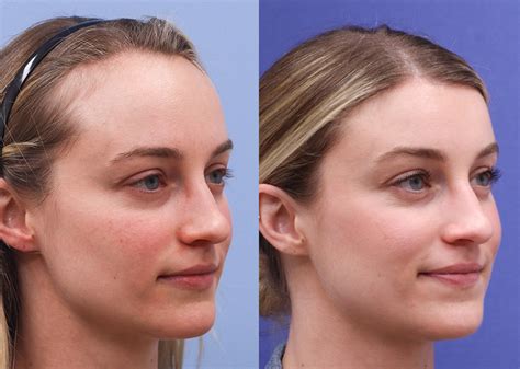 Forehead Reduction Before and After 04