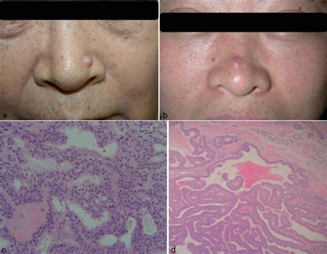 Hidradenoma papilliferum, causes, symptoms, diagnosis, treatment & prognosis