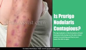 Natural Remedies For Prurigo Nodularis - Top 15 Treatments