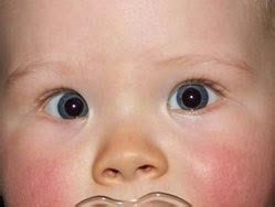 Pseudostrabismus Pictures, Test, Symptoms, Causes, Treatment - Health Care Tips and Natural Remedies