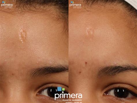 Acne Scarring Laser Treatment Before And After