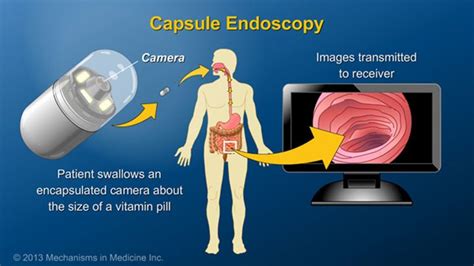 Capsule endoscopy is a relatively new procedure during which the patient swallows an ...