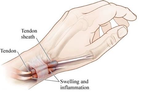 Wrist Tendon Injury | Orchard Health Clinic - Osteopathy, Physiotherapy and Chiropractic