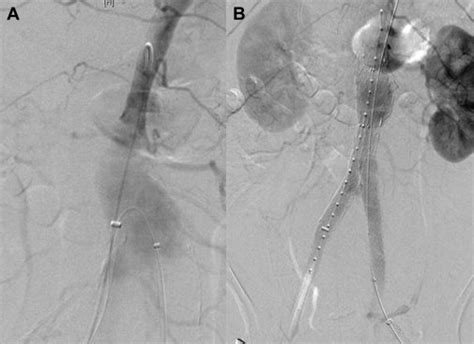 Cheese Wire Fenestration of a Chronic Juxtarenal Dissection Flap to Facilitate Proximal Neck ...